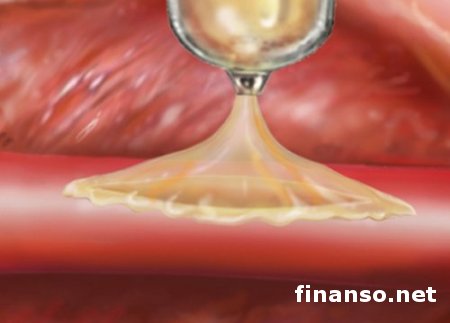 Ученые создали клей, способный "залатать" трещины в сердце и сосудах