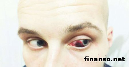 «Тайсон» в ВРУ: оппозиционер откусил ухо лидеру «Азова» в Херсоне