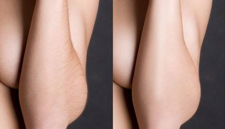 Фотоэпиляция